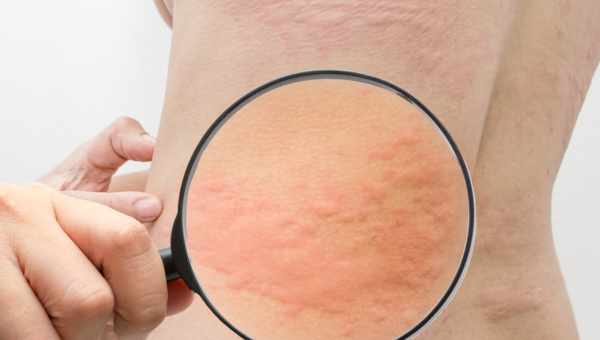 Аллергия. Причины развития и симптомы